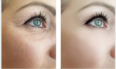 botox before and after