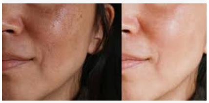 chemical peel before and after